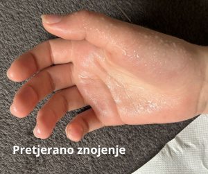 oznojena ruka